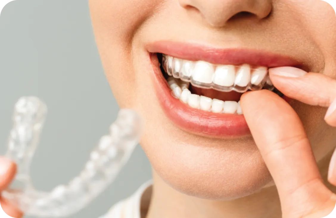 Patient placing clear aligners