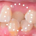 Crossbites