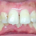 Gaps