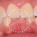 Overbites