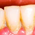 Plaque buildup