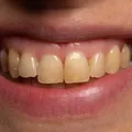 Yellow/discolored teeth