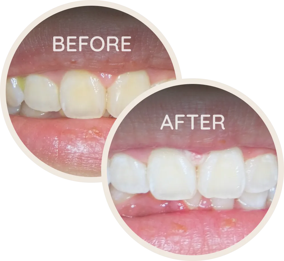 Before and after teeth whitening results