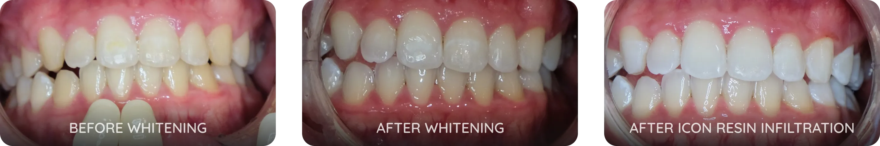 Fluorosis treatment with whitening and ICON Resin Infiltration