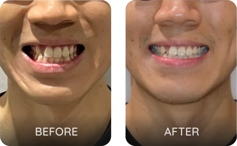 10 weeks of Invisalign for moderate crowding and narrow arch