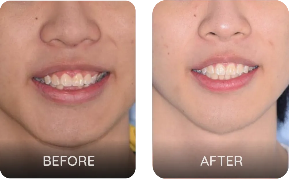 21 weeks of Invisalign for deep bite correction