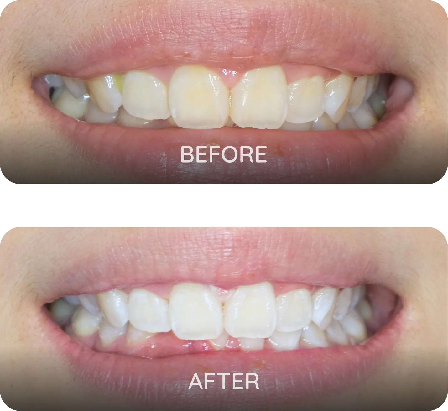 Procedure: In-Office Teeth Whitening