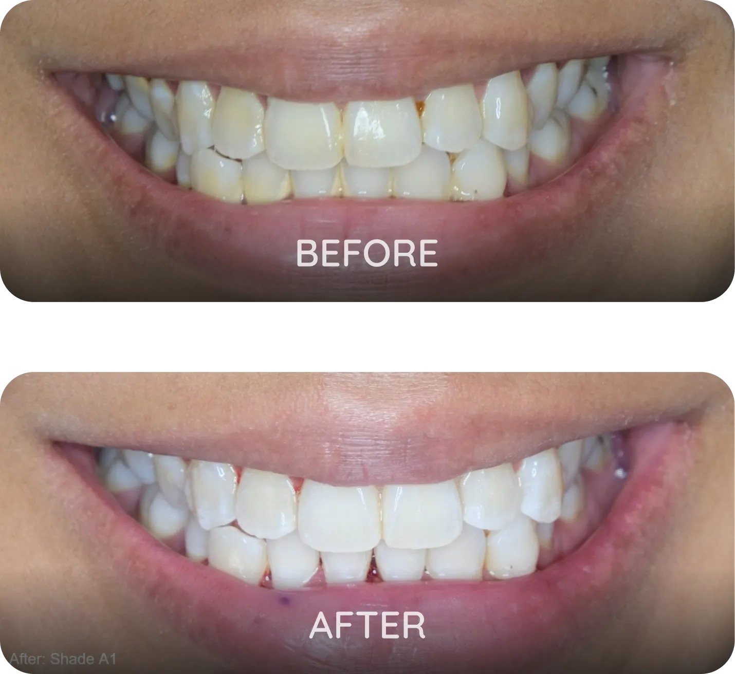 Procedure: Airflow Guided Biofilm Therapy + Express Whitening